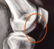 Knie Diagnose: Knorpelschwäche