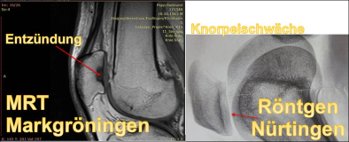 MRT Auswertung Knie versus Röntgen, Sportklinik vs Orthopädie